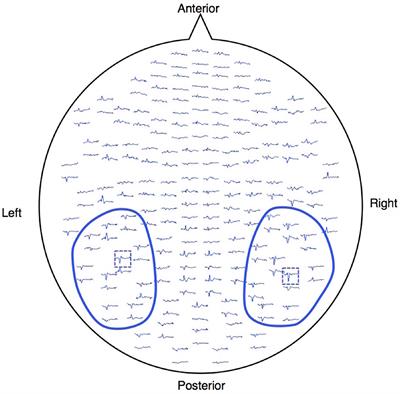 Neurophysiological Face Processing Deficits in Patients With Chronic Schizophrenia: An MEG Study